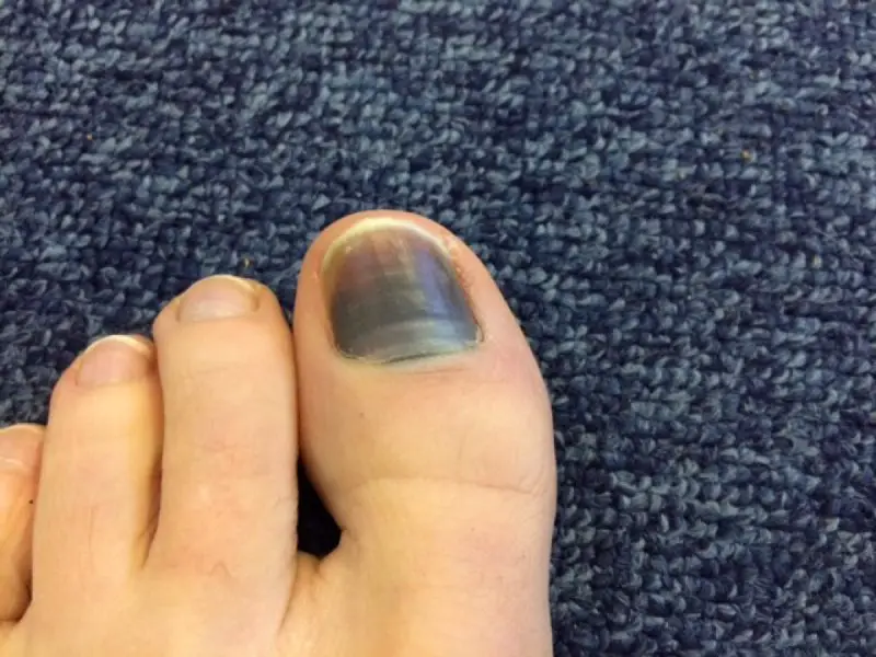 Black toe injury