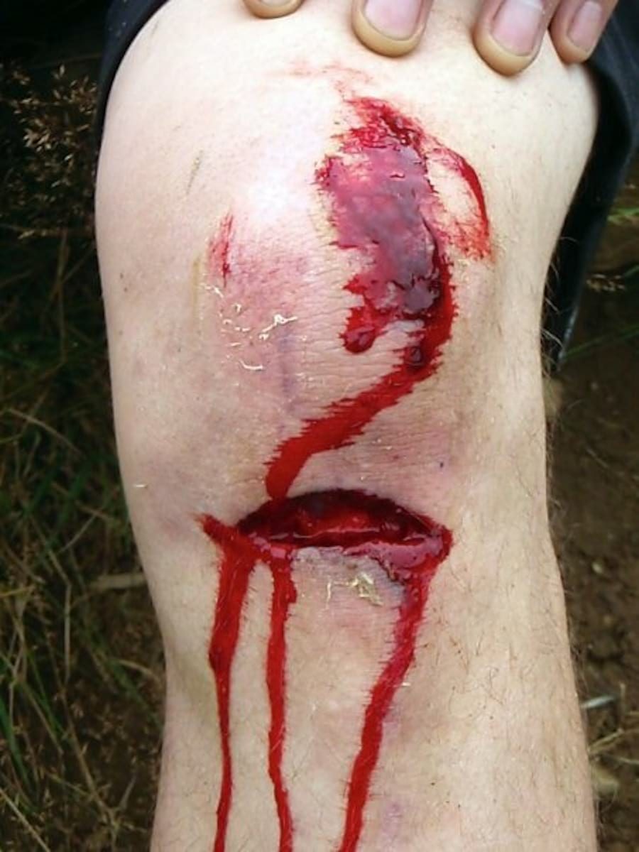 bloody knee injury ouch cut