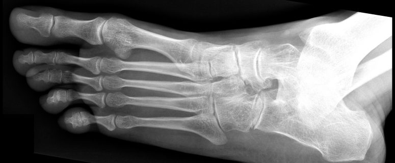 Foot x-ray