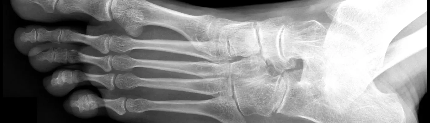 Foot x-ray