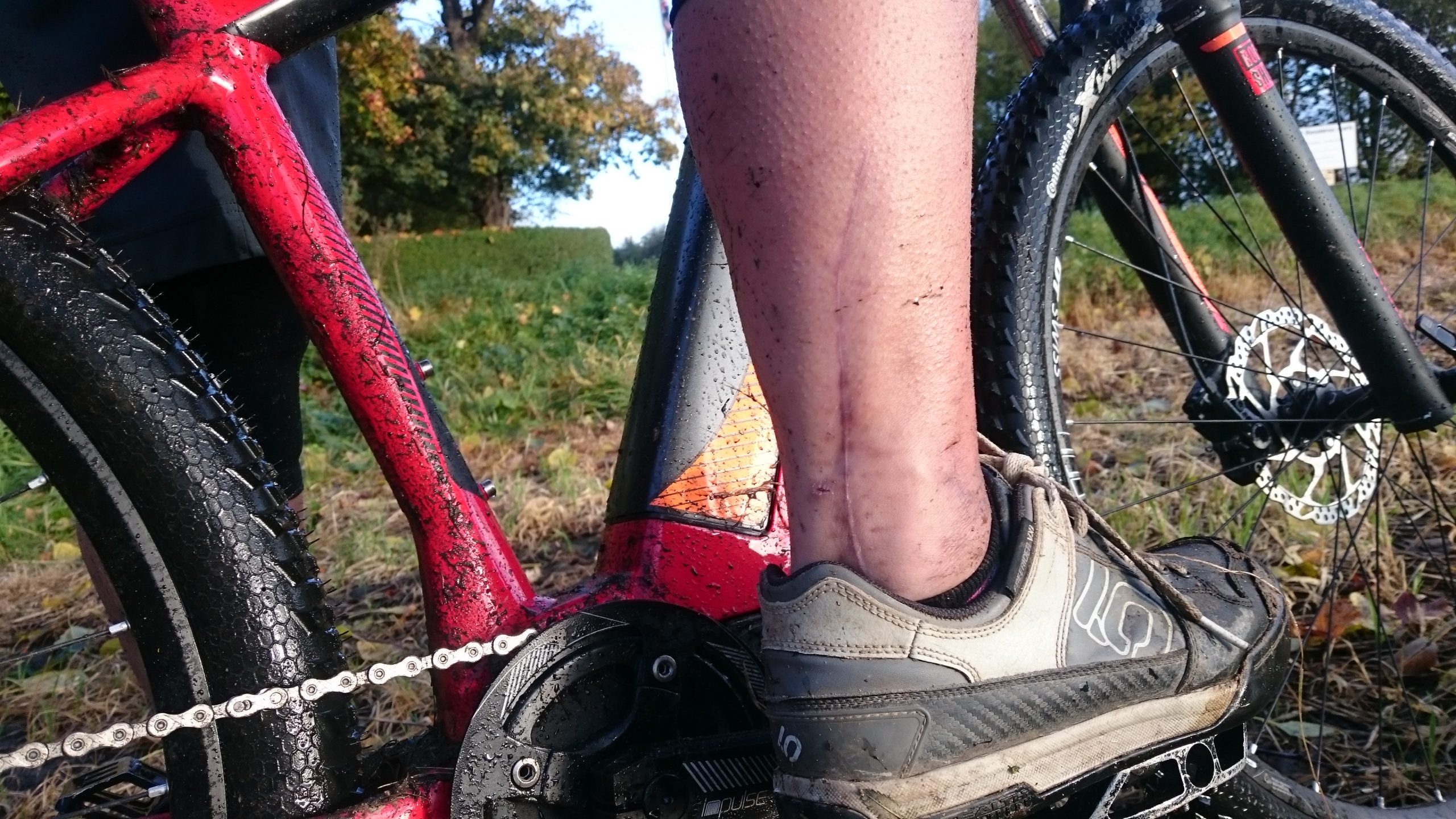 How To Spend A Summer With A Smashed Leg