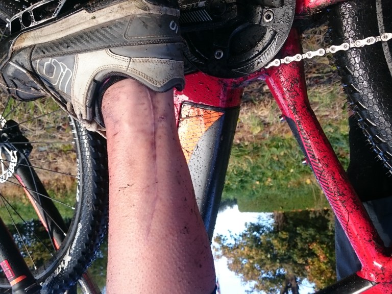 How To Spend A Summer With A Smashed Leg