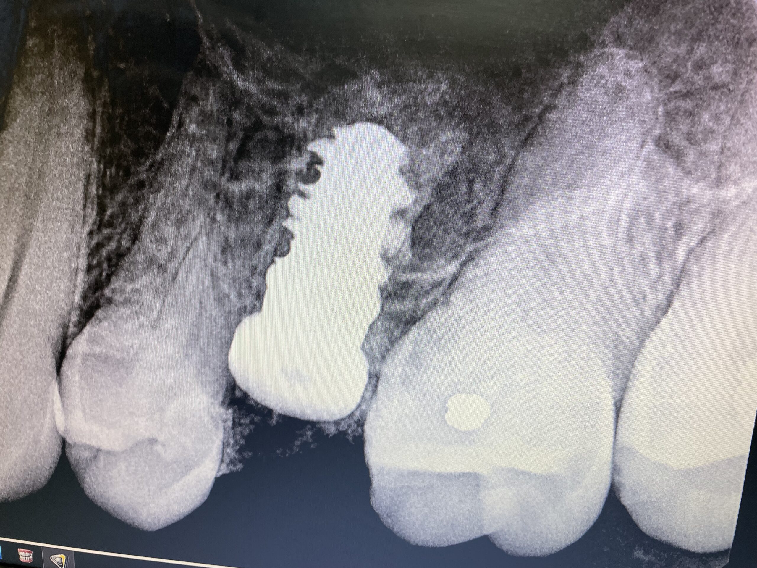 tooth implant